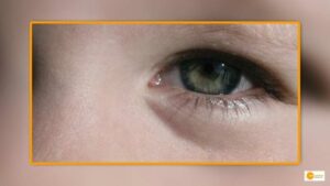 Read more about the article A REMARKABLE OPERATION, THE FIRST OF ITS KIND IN LEBANON, BRINGING A FIVE-YEAR-OLD GIRL BACK FROM THE BRINK OF BLINDNESS!