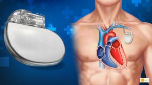 Read more about the article Cardiac Devices Can Be Monitored From Afar
