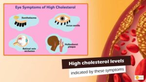 Read more about the article High cholesterol levels may be indicated by these symptoms