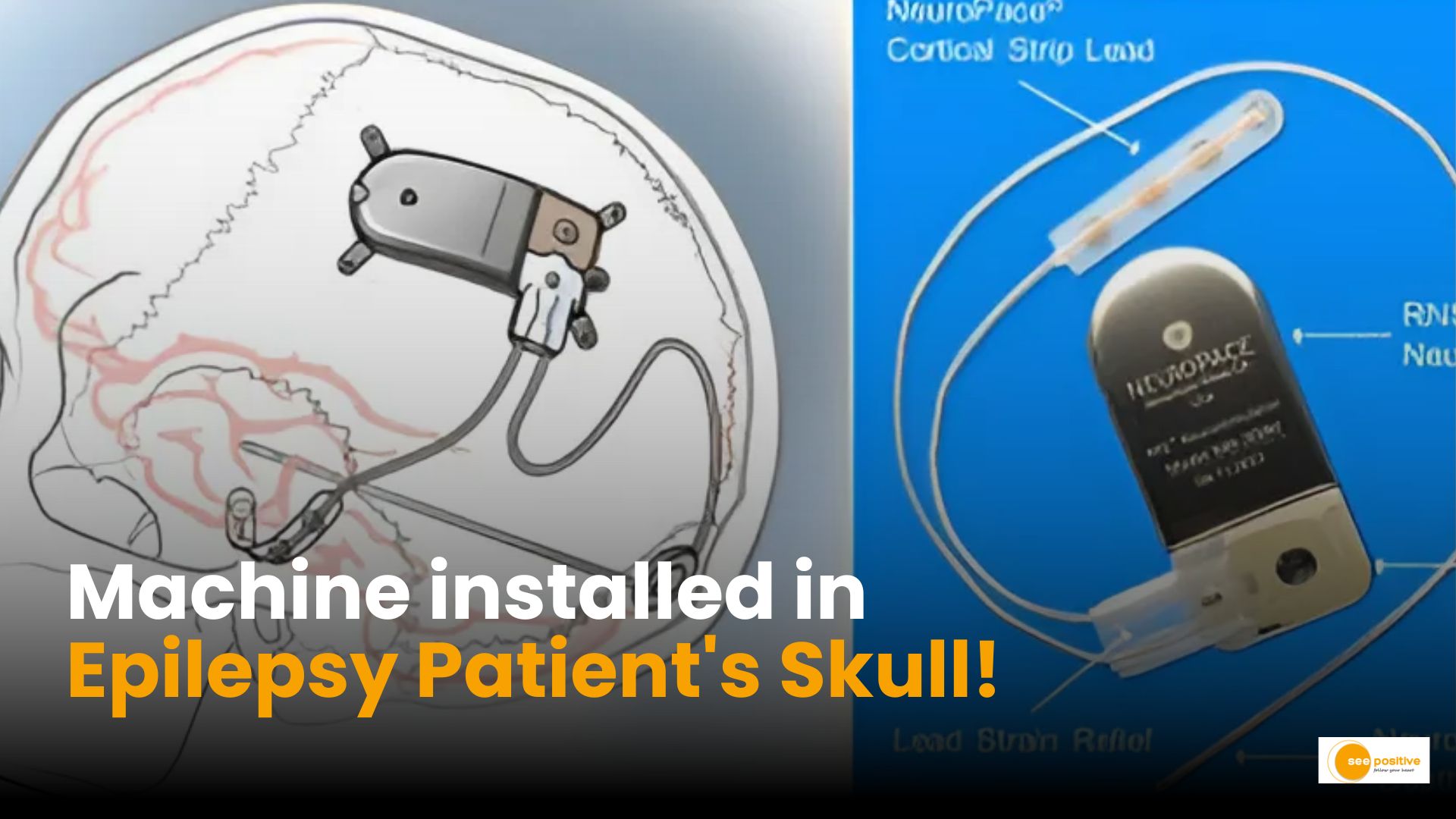 Neurostimulator Device