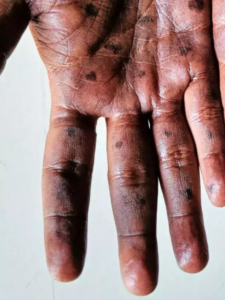 Read more about the article भारत में मंकीपॉक्स (Mpox) – एक नई स्वास्थ्य चुनौती